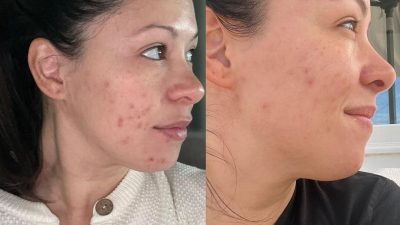 Gallery | Skincare results by Bloom Esthetics