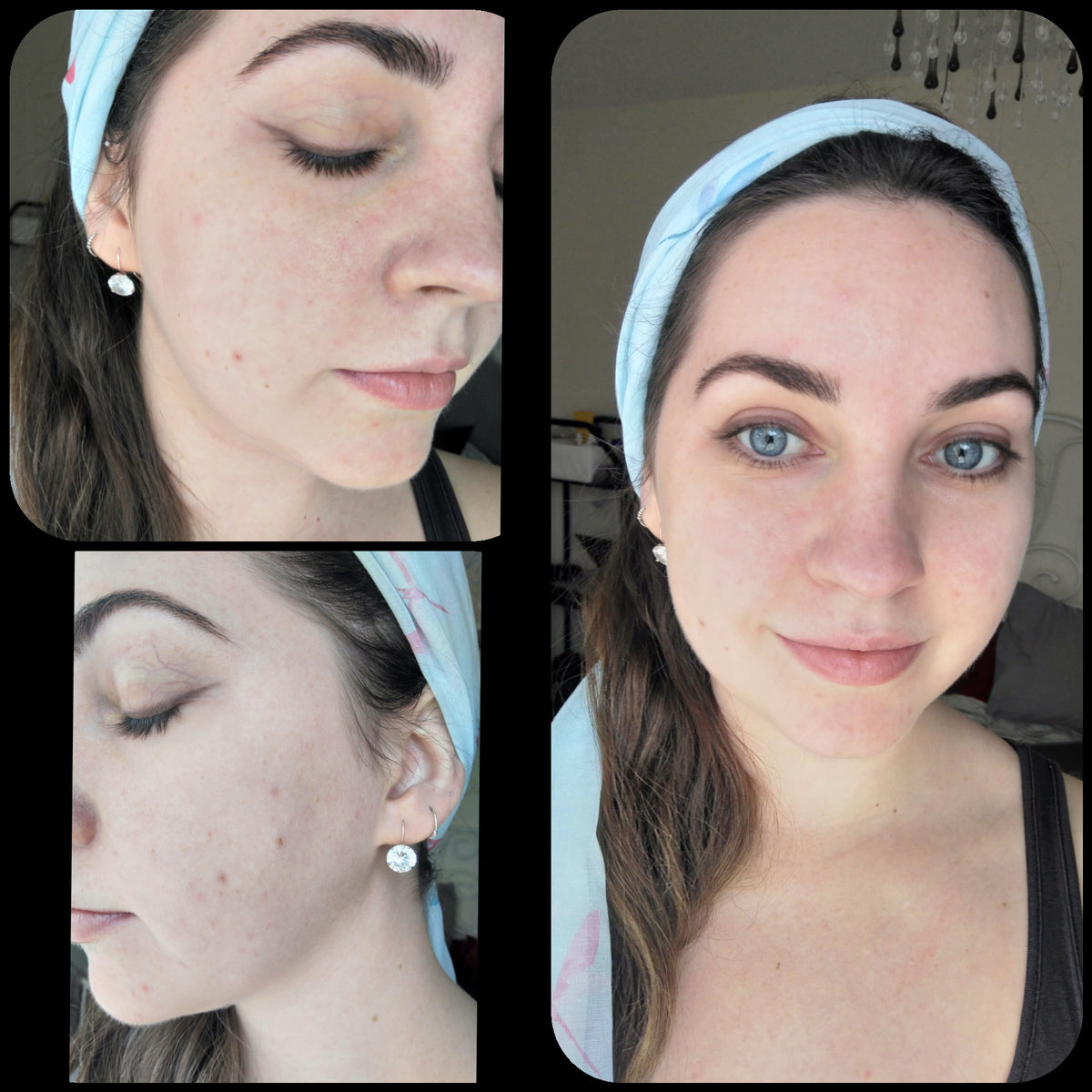 The Ultimate Guide Through the Mandelic Acid Peel