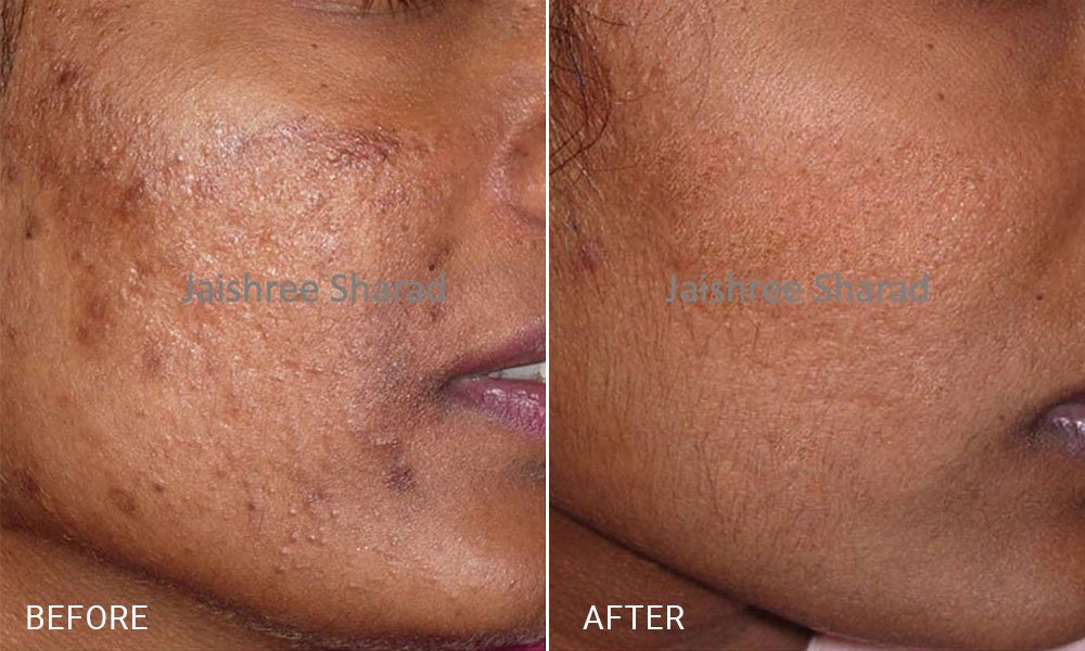 The Ultimate Guide to Chemical Peels for Hyperpigmentation: Reveal Your ...